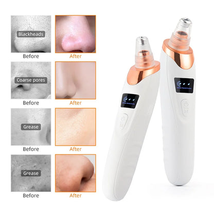 Lulupurest™ Vacuum Blackhead Remover &amp; Facial Pore Cleaner